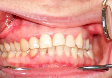 Maloklüzyon. Üst diş eğimi