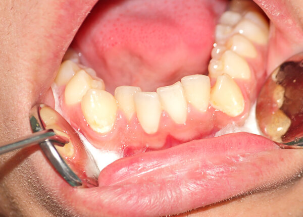 Скопление зубов нижней челюсти
