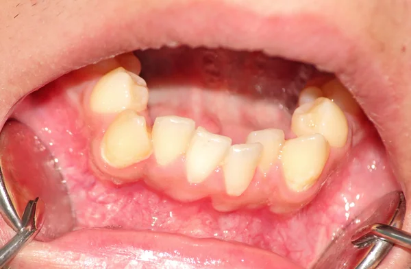 Скопление зубов нижней челюсти Лицензионные Стоковые Фото