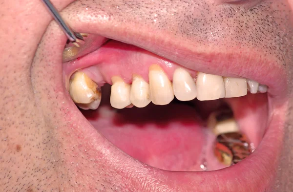 Клиновидный дефект зубов — стоковое фото