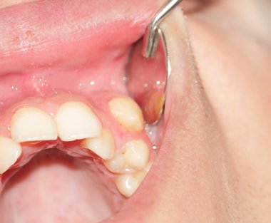 Üst çene dişleri kalabalık