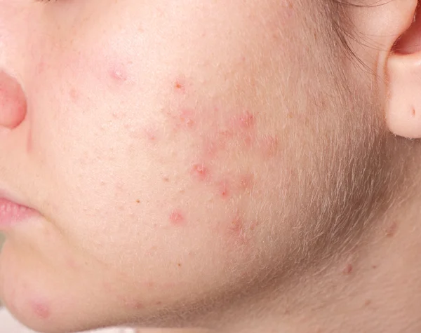 Acne on the girl's face — Stock Photo, Image