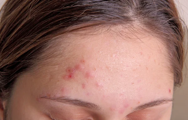 Acne on the girl's forehead — Stock Photo, Image