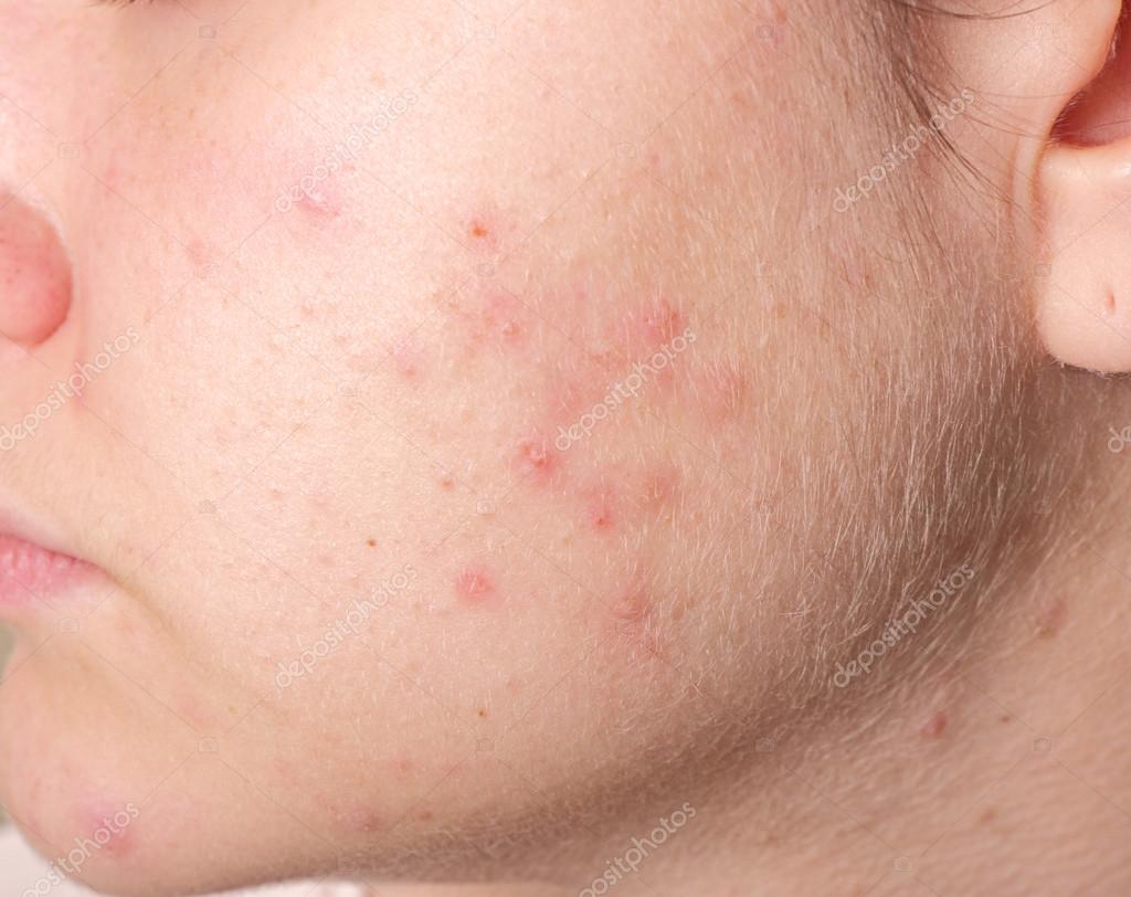 Acne on the girl