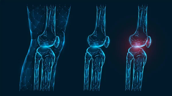 多边形矢量显示大腿和膝关节侧视图 膝关节疾病 疼痛和发炎 浅蓝色背景下人膝部健康受伤的低多模模型 — 图库矢量图片