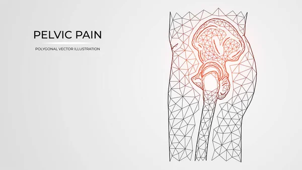 Многоугольная Векторная Иллюстрация Боли Воспаления Травмы Таза Бокового Вида Тазобедренного — стоковый вектор