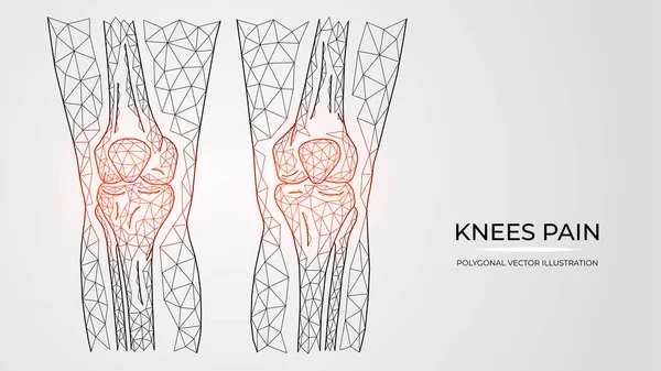 Polygonal Vektor Illustration Smärta Inflammation Eller Skada Knäna Mänskliga Ben — Stock vektor