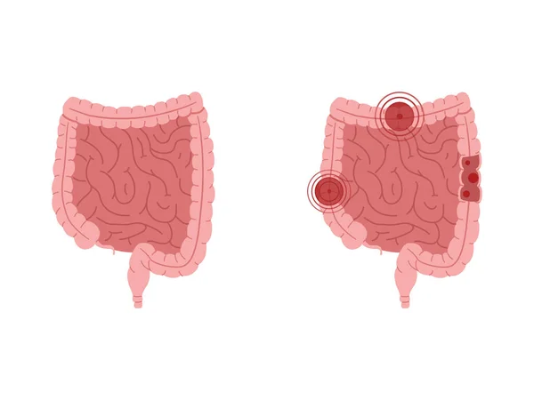 Ilustrasi Vektor Rata Tentang Usus Sehat Dan Usus Dengan Penyakit - Stok Vektor