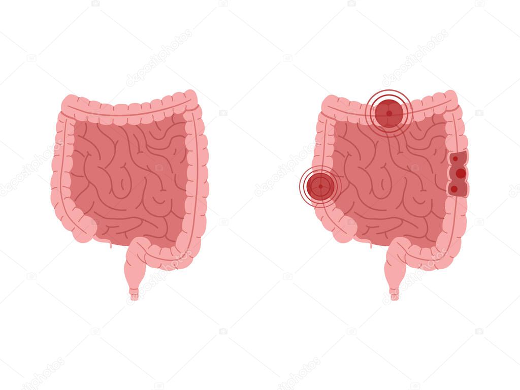 Flat vector illustration of healthy intestines and intestines with inflammatory diseases.