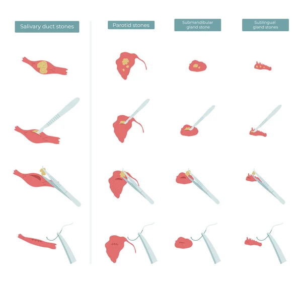 Ilustración Plana Vectorial Cirugía Para Extraer Cálculos Las Glándulas Salivales — Vector de stock