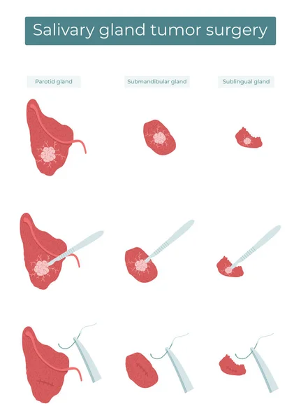 Векторна Плоска Ілюстрація Хірургічного Видалення Пухлини Паротидних Підмозкових Підмозкових Слинних — стоковий вектор
