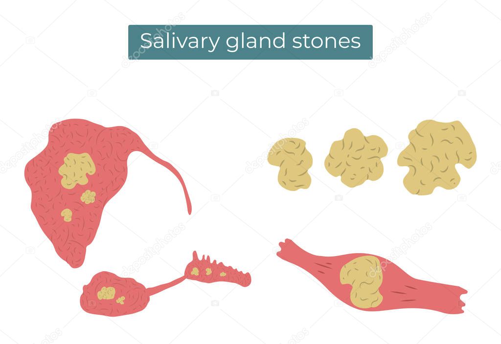 Vector flat illustration of stones in the parotid, submandibular and sublingual salivary glands and duct.