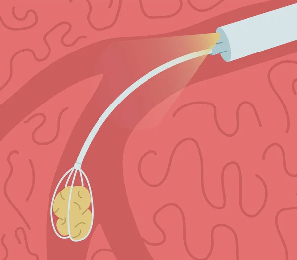 Remoção Uma Pedra Ducto Glândula Salivar Ilustração Vetorial Sialoendoscopia — Vetor de Stock