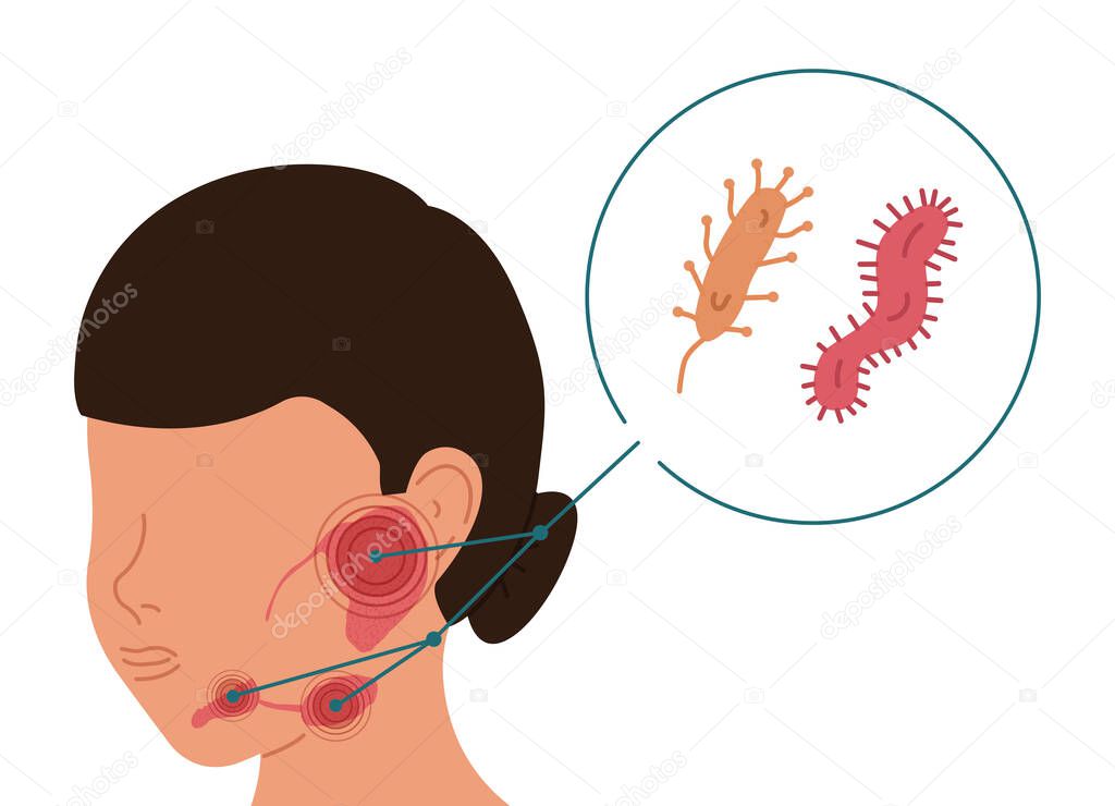 A woman with bacterial inflammation of the salivary glands. Vector illustration of sialolithiasis.