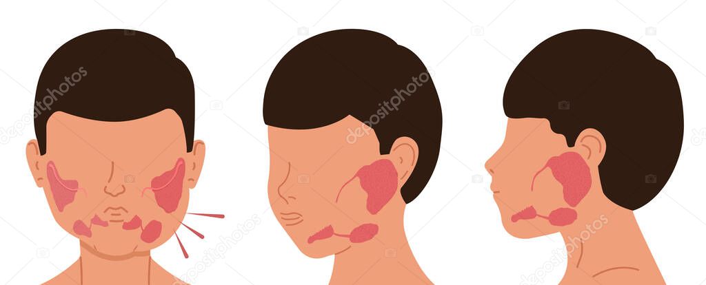Person with sick and healthy salivary glands. Vector illustration of sialolithiasis.