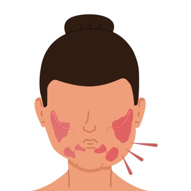 İltihaplı tükürük bezleri olan bir kadın. Tıbbi vektör illüstrasyonu.