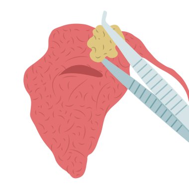 Parotid tükürük bezinden bir taşı çıkarmanın vektör çizimi. Sialolithiasis