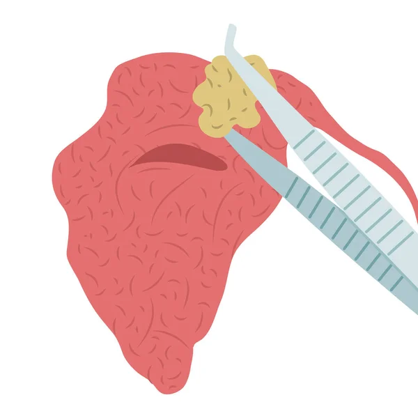 Ilustración Vectorial Remover Una Piedra Glándula Salival Parótida Sialolitiasis — Vector de stock