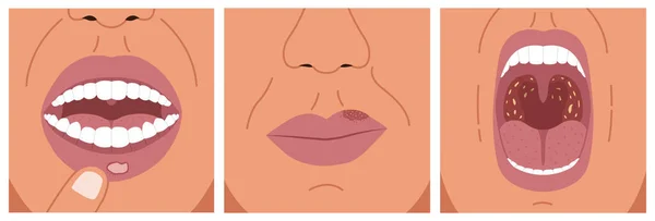 Dolor Estómago Herpes Labial Dolor Garganta Ilustración Vectorial Úlcera Aftosa — Vector de stock