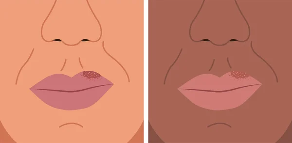 Ilustración Vectorial Herpes Labio Herpes Labial Herpes Simple — Archivo Imágenes Vectoriales