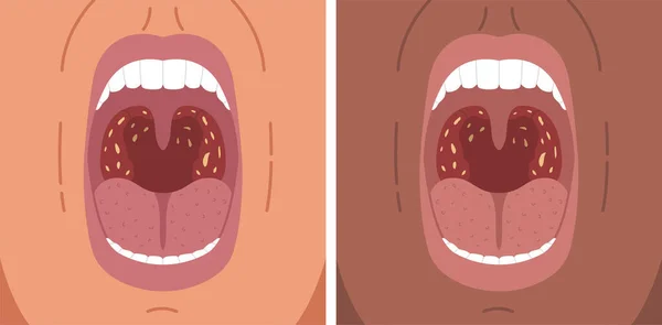 細菌性扁桃炎 喉の痛み 扁桃腺石のベクトル図 — ストックベクタ