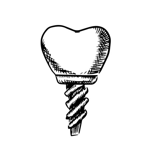 Isolierte Skizze eines Zahnimplantats — Stockvektor