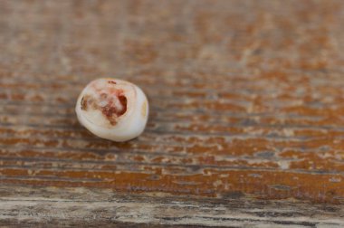 Diş çürüğünün resmi, süt dişleri.