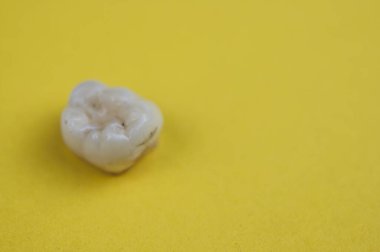 Diş çürüğünün resmi, süt dişleri.