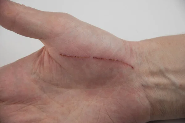 Tangan Seorang Pria Terluka Karena Kecelakaan Konsep Asuransi — Stok Foto