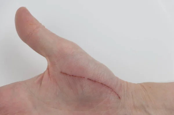 Χέρι Του Ανθρώπου Τραυματίστηκε Από Ατύχημα Ασφαλιστική Έννοια — Φωτογραφία Αρχείου