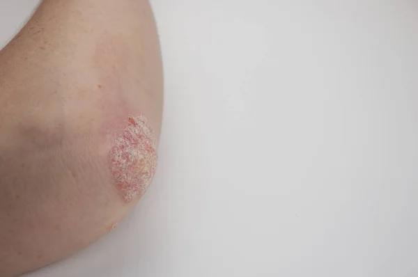 白い背景に肘の乾癬 — ストック写真