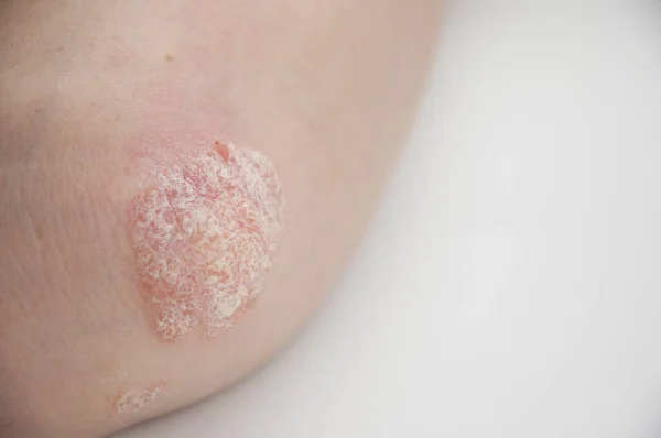 Psoriasis Elleboog Witte Achtergrond — Stockfoto