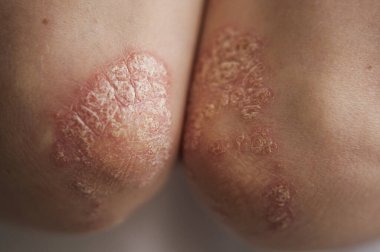 Dirseklerdeki akut sedef hastalığı otoimmün, tedavisi olmayan dermatolojik bir hastalıktır. Büyük kırmızı, iltihaplı, dirseklerinde döküntü var. Sedef hastalığından etkilenmiş eklemler.