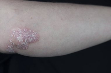 Dirseklerdeki akut sedef hastalığı otoimmün, tedavisi olmayan dermatolojik bir hastalıktır. Büyük kırmızı, iltihaplı, dirseklerinde döküntü var. Sedef hastalığından etkilenmiş eklemler.