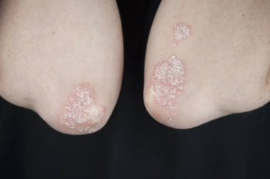 Dirseklerdeki akut sedef hastalığı otoimmün, tedavisi olmayan dermatolojik bir hastalıktır. Büyük kırmızı, iltihaplı, dirseklerinde döküntü var. Sedef hastalığından etkilenmiş eklemler.