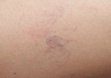 Deride varis damarları var. makro 