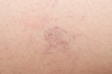 Deride varis damarları var. makro 