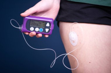 Ensülin pompalı diyabetik bir çocuğa yakından bakın. Çocuk Diyabet Konsepti.