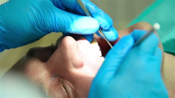 Dentista instala implante nos dentes dianteiros. Fecha. Efeito de movimento lento — Vídeo de Stock