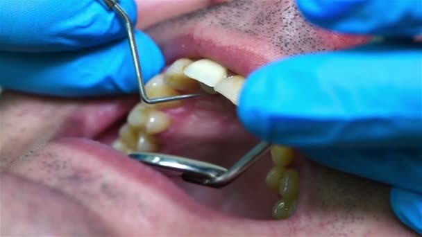 Un dentista che controlla la bocca di un paziente in clinica. Estremo Primo Piano — Video Stock