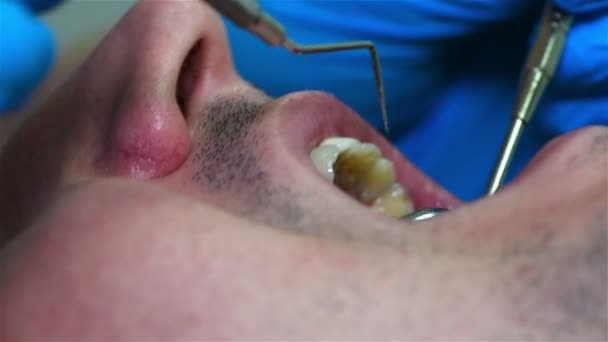 Дантист проверяет зуб пациента — стоковое видео