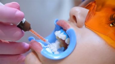 Dişçi hastanın dişlerine beyazlatıcı jel sürüyor. Diş Kliniğinde Diş beyazlatma. Sağlık ve Tıp Konsepti 'nden. Kapat.
