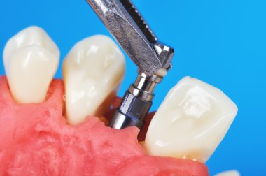 cımbız holding diş implant