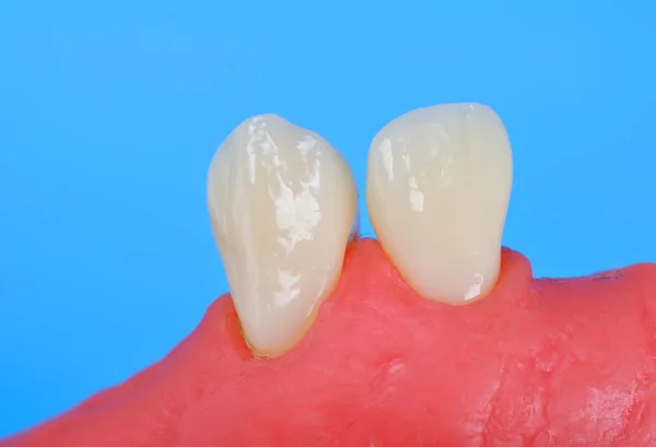 Due denti — Foto Stock