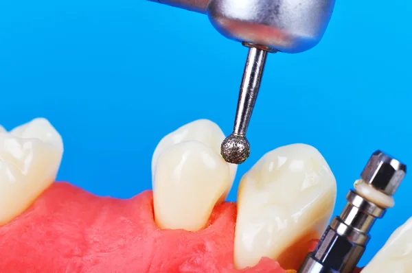 Vrtačky a zubní implantát — Stock fotografie
