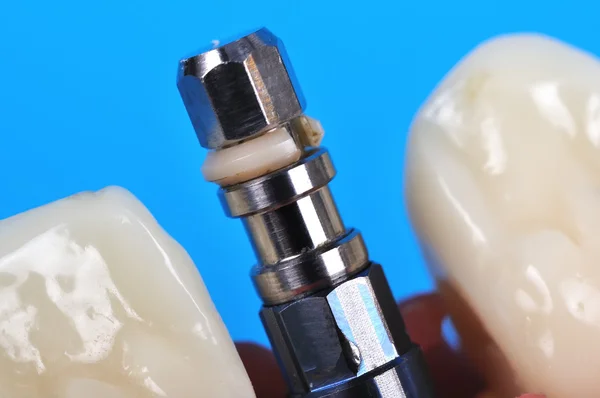 Dental implant — Stock Photo, Image