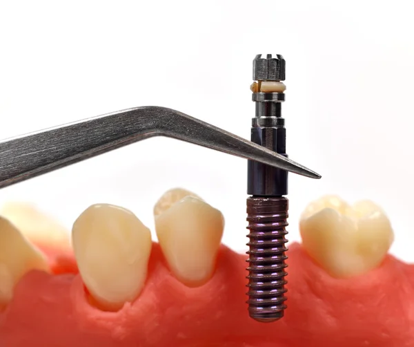 Pinzety s zubní implantát — Stock fotografie