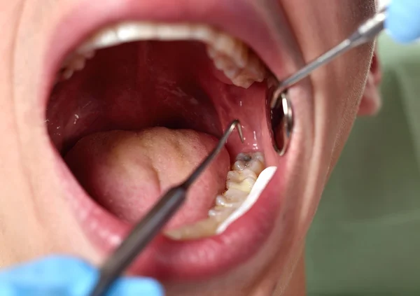 Patienten öppnar munnen — Stockfoto