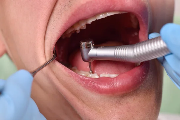 Dentista usando taladro — Foto de Stock