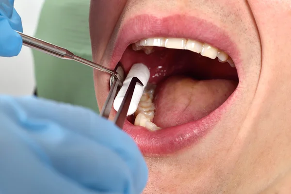 The dentist inserts the swab — Stock Photo, Image